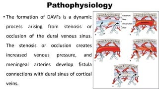 Pathophysiology
• The formation of DAVFs is a dynamic
process arising from stenosis or
occlusion of the dural venous sinus.
The stenosis or occlusion creates
increased venous pressure, and
meningeal arteries develop fistula
connections with dural sinus of cortical
veins.
 