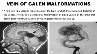 VEIN OF GALEN MALFORMATIONS
• A rare high-flow vascular malformation of the brain in which there is marked dilatation of
the venous system. It is a congenital malformation of blood vessels of the brain that
occurs prior to birth, most likely between gestational weeks 6 and 11.
 
