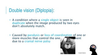 Double vision (Diplopia):
• A condition where a single object is seen in
duplicate when the image produced by two eyes
don’t absolutely match.
• Caused by paralysis or loss of coordination of one or
more muscles that control the one eye movement
due to a cranial nerve palsy
TUESDAY 8/9/2016
 