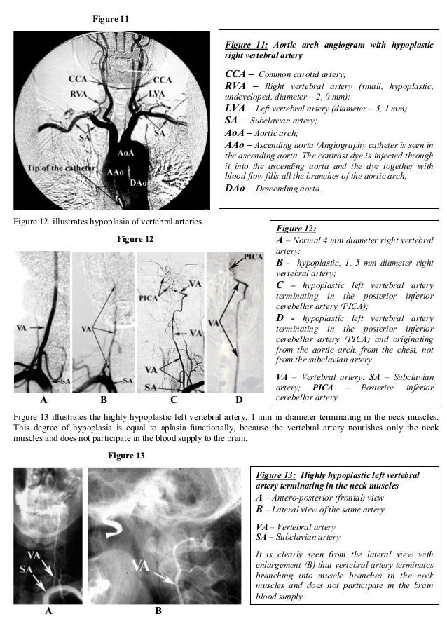 Cerebrovascular Disease, Cerebrovascular Insufficiency, Vertebrobasi…