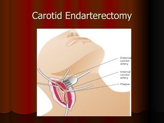Carotid Endarterectomy 