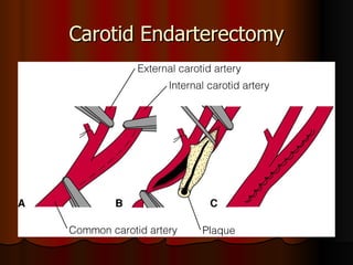 Carotid Endarterectomy 
