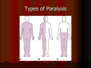 Types of Paralysis 
