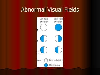 Abnormal Visual Fields 