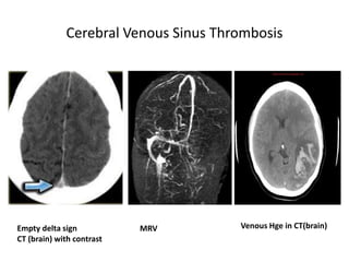 Cerebrovascular diseases 2.pptx