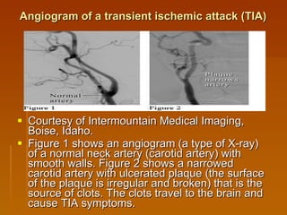 Courtesy of Intermountain Medical Imaging, Boise, Idaho.  Figure 1 shows an angiogram (a type of X-ray) of a normal neck artery (carotid artery) with smooth walls. Figure 2 shows a narrowed carotid artery with ulcerated plaque (the surface of the plaque is irregular and broken) that is the source of clots. The clots travel to the brain and cause TIA symptoms. Angiogram of a transient ischemic attack (TIA) 