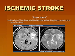 ISCHEMIC STROKE “ brain attack” sudden loss of functional resulting from disruption of the blood supply to the part of the brain. 