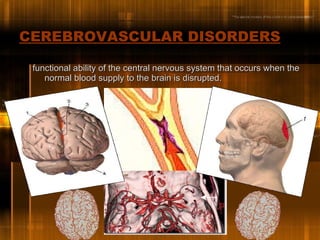 CEREBROVASCULAR DISORDERS   ,[object Object]