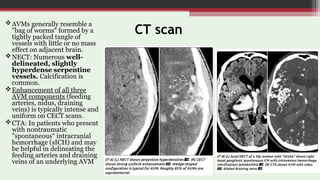 Imaging in Cerebrovascular Malformations | PPT
