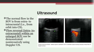 Imaging in Cerebrovascular Malformations | PPT