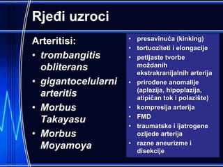 Rjeđi uzroci
Arteritisi:
• trombangitis
obliterans
• gigantocelularni
arteritis
• Morbus
Takayasu
• Morbus
Moyamoya
• presavinuća (kinking)
• tortuoziteti i elongacije
• petljaste tvorbe
moždanih
ekstrakranijalnih arterija
• prirođene anomalije
(aplazija, hipoplazija,
atipičan tok i polazište)
• kompresija arterija
• FMD
• traumatske i ijatrogene
ozljede arterija
• razne aneurizme i
disekcije
 