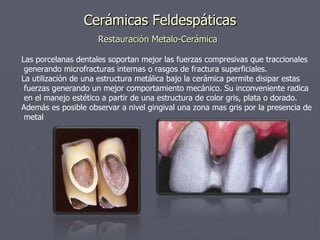 Cerámicas Feldespáticas Restauración Metalo-Cerámica   Las porcelanas dentales soportan mejor las fuerzas compresivas que traccionales generando microfracturas internas o rasgos de fractura superficiales. La utilización de una estructura metálica bajo la cerámica permite disipar estas fuerzas generando un mejor comportamiento mecánico. Su inconveniente radica en el manejo estético a partir de una estructura de color gris, plata o dorado. Además es posible observar a nivel gingival una zona mas gris por la presencia de metal  