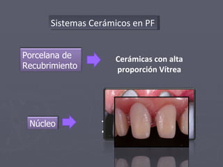 Sistemas Cerámicos en PF Metal Cerámicas reforzadas Cerámicas con alta proporción Vítrea Porcelana de Recubrimiento  Núcleo 