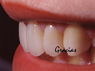 Gracias 