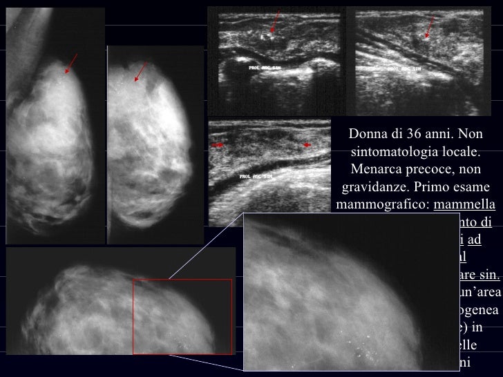 cerone-risonanza-magnetica-nel-carcinoma-della-mammella