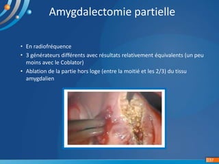 • En radiofréquence
• 3 générateurs différents avec résultats relativement équivalents (un peu
moins avec le Coblator)
• Ablation de la partie hors loge (entre la moitié et les 2/3) du tissu
amygdalien
17
Amygdalectomie partielle
 