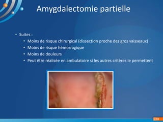 • Suites :
• Moins de risque chirurgical (dissection proche des gros vaisseaux)
• Moins de risque hémorragique
• Moins de douleurs
• Peut être réalisée en ambulatoire si les autres critères le permettent
18
Amygdalectomie partielle
 