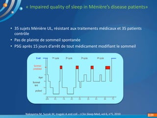 « Impaired quality of sleep in Ménière’s disease patients»
Nakayama M, Suzuki M, Inagaki A and coll - J Clin Sleep Med, vol 6, n°5, 2010 36
• 35 sujets Ménière UL, résistant aux traitements médicaux et 35 patients
contrôle
• Pas de plainte de sommeil spontanée
• PSG après 15 jours d’arrêt de tout médicament modifiant le sommeil
 