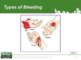 Types of Bleeding(image)
PM 3-3
CERT Basic Training Unit 3: Disaster Medical Operations – Part 1 3-8
 