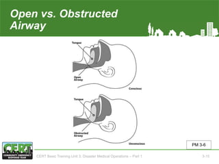 Open vs. Obstructed
Airway
PM 3-6
CERT Basic Training Unit 3: Disaster Medical Operations – Part 1 3-15
 