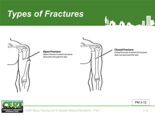 Types of Fractures(1 of 2)
PM 3-12
CERT Basic Training Unit 3: Disaster Medical Operations – Part 1 3-32
 