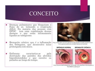  Doenças pulmonares que bloqueiam o
fluxo de ar, tornando a respiração
difícil. Na maioria das pessoas com
DPOC tem uma combinação dessas
doenças e que estão intimamente
ligadas ao tabagismo:
 Bronquite crônica: que é a inflamação
dos brônquios, que desenvolve tosse
prolongada com muco.
 Enfisema: caracteriza-se pela
destruição das paredes dos alvéolos
hiperdistendidos e que envolve os
pulmões ao longo do tempo.
CONCEITO
http://www.lookfordiagnosis.com/mesh_info.php?term=bronquite+cr
%C3%B4nica&lang=3
http://veja.abril.com.br/noticia/mundo/arabia-saudita-proibe-fumar-
nos-lugares-publicos-e-vender-tabaco-a-menores
 