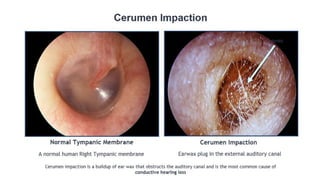 conditions of the external ear cerumen impaction | PPTX