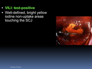 Aboubakr Elnashar
 VILI: test-positive
 Well-defined, bright yellow
iodine non-uptake areas
touching the SCJ
 