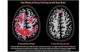 Understanding Adolescent Substance Dependence and Brain Impact | PDF