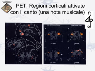 PET: Regioni corticali attivate
con il canto (una nota musicale)
 