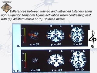 Differences between trained and untrained listeners show
right Superior Temporal Gyrus activation when contrasting rest
with (a) Western music or (b) Chinese music.
 