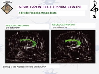Fibre del Fascicolo Arcuato destro
LA RIABILITAZIONE DELLE FUNZIONI COGNITIVE
FASCICOLO ARCUATO dx
post-trattamento
FASCICOLO ARCUATO dx
pre-trattamento
Schlaug G. The Neurosciences and Music III 2009
 