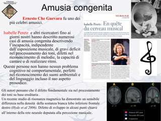 Amusia congenita
Ernesto Che Guevara fu uno dei
più celebri amusici.
Isabelle Peretz e altri ricercatori fino ai
giorni nostri hanno descritto numerosi
casi di amusia congenita descrivendo
l’incapacità, indipendente
dall’esposizione musicale, di gravi deficit
nel processamento dei toni, difetti nel
riconoscimento di melodie, la capacità di
cantare o di realizzare ritmi.
Queste persone non hanno nessun problema
cognitivo né comportamentale, perfetti
nel riconoscimento dei suoni ambientali e
del linguaggio incluso il suo aspetto
prosodico.
Gli autori pensano che il difetto fondamentale sia nel processamento
dei toni su base ereditaria .
Un recente studio di risonanza magnetica ha dimostrato un sensibile
differenza nella densità della sostanza bianca lobo inferiore frontale
destro (Hyde et al 2006). Difetto di sviluppo in alcuni punti chiave
all’interno della rete neurale deputata alla percezione musicale.
 