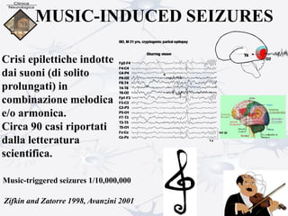 MUSIC-INDUCED SEIZURES
Crisi epilettiche indotte
dai suoni (di solito
prolungati) in
combinazione melodica
e/o armonica.
Circa 90 casi riportati
dalla letteratura
scientifica.
Music-triggered seizures 1/10,000,000
Zifkin and Zatorre 1998, Avanzini 2001
 