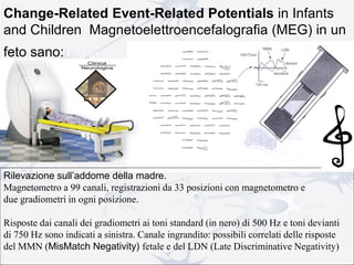 Change-Related Event-Related Potentials in Infants
and Children Magnetoelettroencefalografia (MEG) in un
feto sano:
Rilevazione sull’addome della madre.
Magnetometro a 99 canali, registrazioni da 33 posizioni con magnetometro e
due gradiometri in ogni posizione.
Risposte dai canali dei gradiometri ai toni standard (in nero) di 500 Hz e toni devianti
di 750 Hz sono indicati a sinistra. Canale ingrandito: possibili correlati delle risposte
del MMN (MisMatch Negativity) fetale e del LDN (Late Discriminative Negativity)
 