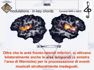 Oltre che le aree fronto-laterali inferiori, si attivano
bilateralmente anche le aree temporali (a sinistra
l’area di Wernicke) per la processazione di eventi
musicali strutturalmente inadeguati.
fMRI
Correlati fMRI e MEG
 