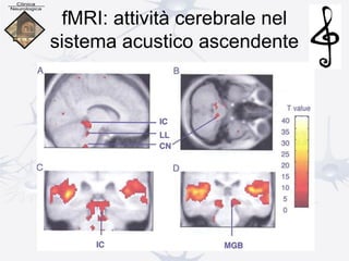 fMRI: attività cerebrale nel
sistema acustico ascendente
 