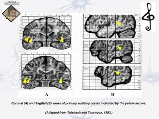 Coronal (A) and Sagittal (B) views of primary auditory cortex indicated by the yellow arrows.
(Adapted from Talairach and Tournoux, 1993.)
 