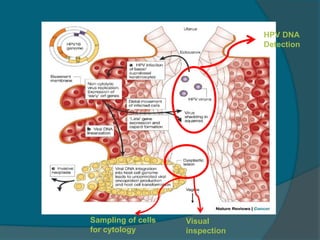 HPV DNA
Detection
Sampling of cells
for cytology
Visual
inspection
 