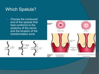 Which Spatula?
 Choose the contoured
end of the spatula that
best conforms to the
anatomy of the cervix
and the location of the
transformation zone
 