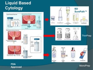 Liquid Based
Cytology BD
SurePath™
ThinPrep
MonoPrep
FDA
Approved
 