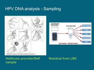 HPV DNA analysis - Sampling
Helthcare provider/Self
sample
Residual from LBC
 