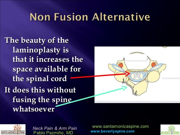 Cervical Laminoplasty by Pablo Pazmino MD Cervical Laminoplasty by Pablo Pazmino MD