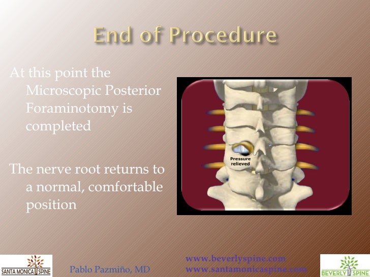 Cervical Posterior Foraminotomy by Pablo Pazmino MD