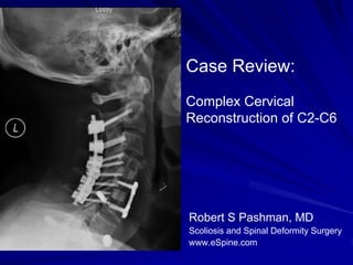 Case Review:
Complex Cervical
Reconstruction of C2-C6




Robert S Pashman, MD
Scoliosis and Spinal Deformity Surgery
www.eSpine.com
 