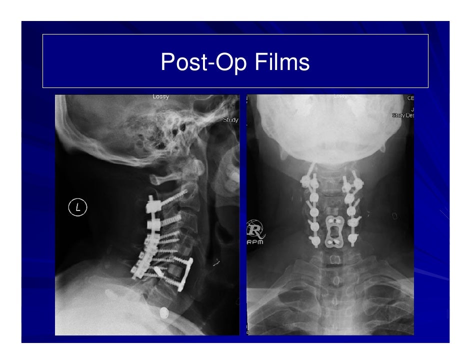 Case Review #5: 62 year old male with degenerative disc disease C2-C6