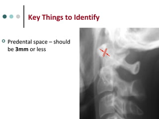 Key Things to Identify
 Predental space – should
be 3mm or less
 