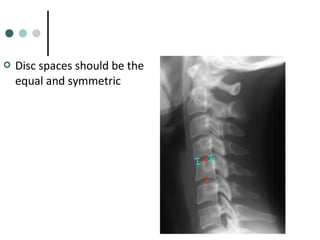  Disc spaces should be the
equal and symmetric
 