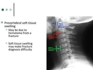  Prevertebral soft tissue
swelling
 May be due to
hematoma from a
fracture
 Soft tissue swelling
may make fracture
diagnosis difficulty
 