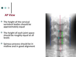 AP View
 The height of the cervical
vertebral bodies should be
approximately equal
 The height of each joint space
should be roughly equal at all
levels
 Spinous process should be in
midline and in good alignment
 